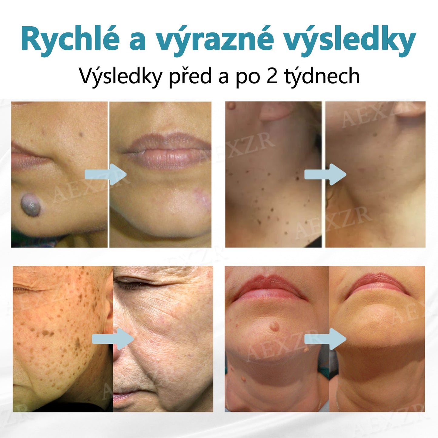 【Oficiální vlajkový obchod】Foulme® PRO Neinvazivní laserové pero na odstraňování bradavic a znamének💥