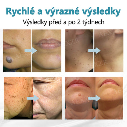 【Oficiální vlajkový obchod】Foulme® PRO Neinvazivní laserové pero na odstraňování bradavic a znamének💥
