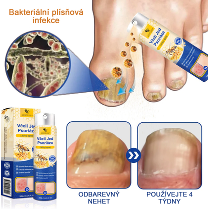🔥Platba při převzetí🔥 60% sleva LOVILDS™ PsoriaHeal sprej na lupénku (doručení po celém světě – doprava zdarma)
