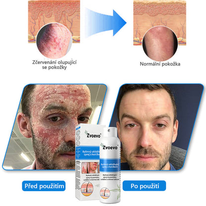 ✅Zvoevo® Magnesium bylinný sprej ⚕️ Certifikace MHRA – úleva při psoriáze, ekzému, intimních bakteriálních infekcích, akné a tmavých skvrnách