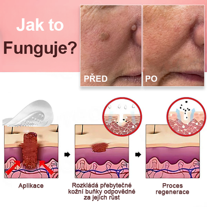 KUBOZN® Náplasti na odstranění kožních výrůstků s nano-mikrojehličkami