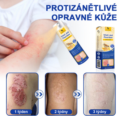 🔥Platba při převzetí🔥 60% sleva LOVILDS™ PsoriaHeal sprej na lupénku (doručení po celém světě – doprava zdarma)