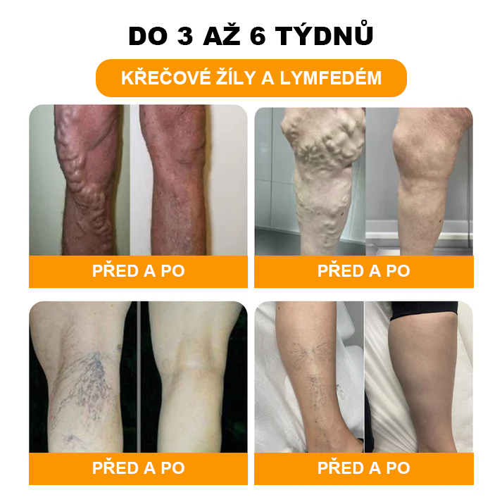 ⏰ RevivaFoot™ Mélthin lymfatické odvodňovací a zeštíhlující šumivé koule do koupele na nohy, snižují otoky až o 70 %【Podpora lymfatického oběhu – řešení problému od samotné příčiny】⏰