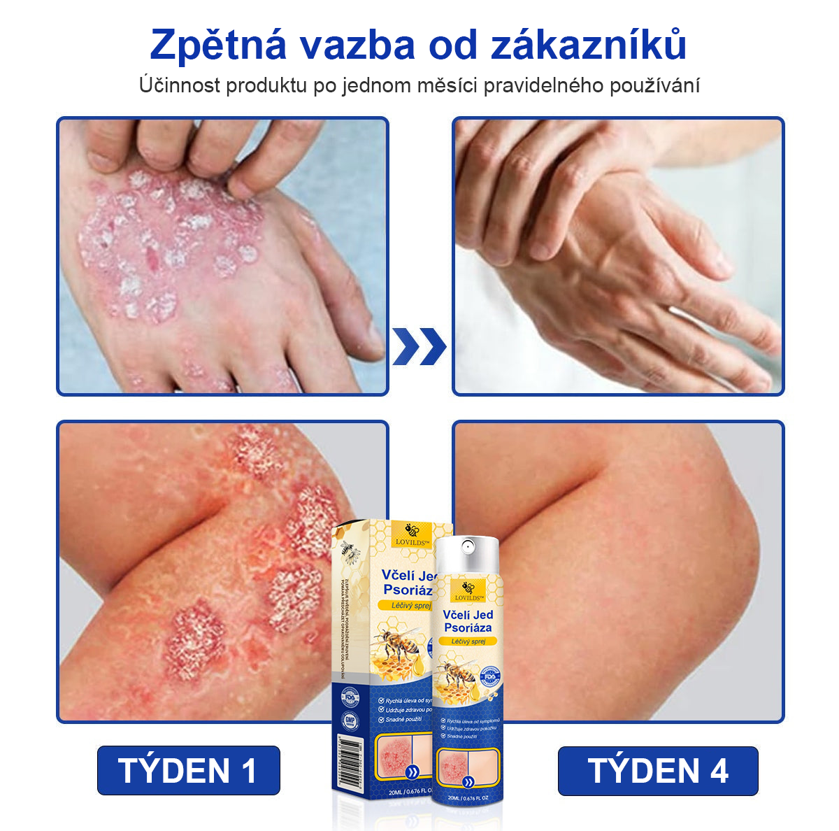 🔥Platba při převzetí🔥 60% sleva LOVILDS™ PsoriaHeal sprej na lupénku (doručení po celém světě – doprava zdarma)