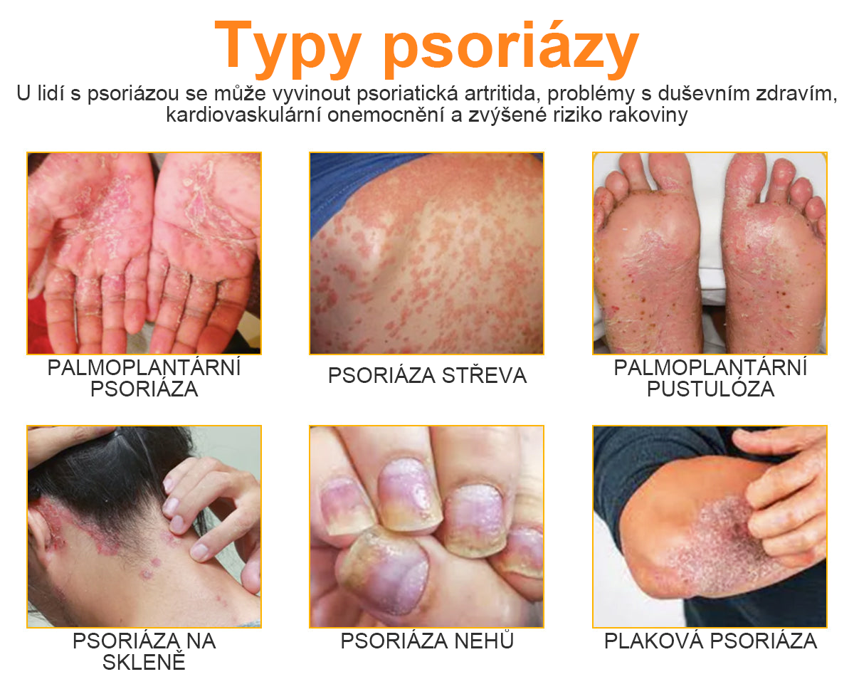 🔥Platba při převzetí🔥 60% sleva LOVILDS™ PsoriaHeal sprej na lupénku (doručení po celém světě – doprava zdarma)