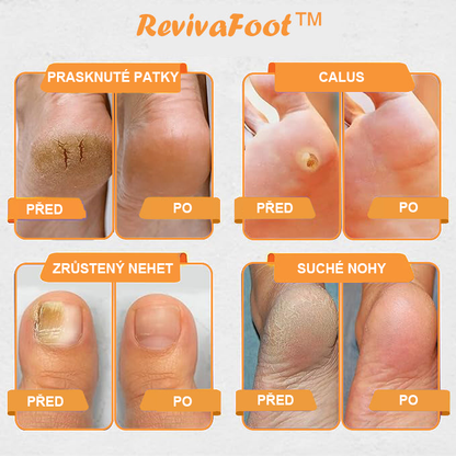 ⏰ RevivaFoot™ Mélthin lymfatické odvodňovací a zeštíhlující šumivé koule do koupele na nohy, snižují otoky až o 70 %【Podpora lymfatického oběhu – řešení problému od samotné příčiny】⏰