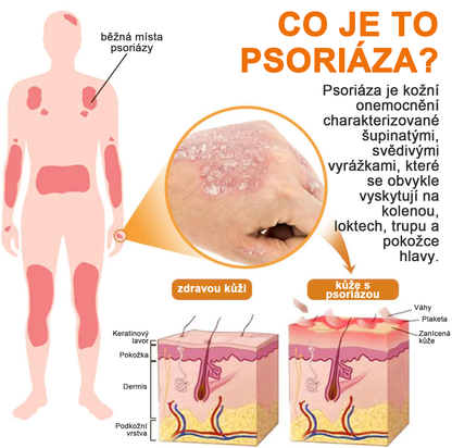 🔥Platba při převzetí🔥 60% sleva LOVILDS™ PsoriaHeal sprej na lupénku (doručení po celém světě – doprava zdarma)
